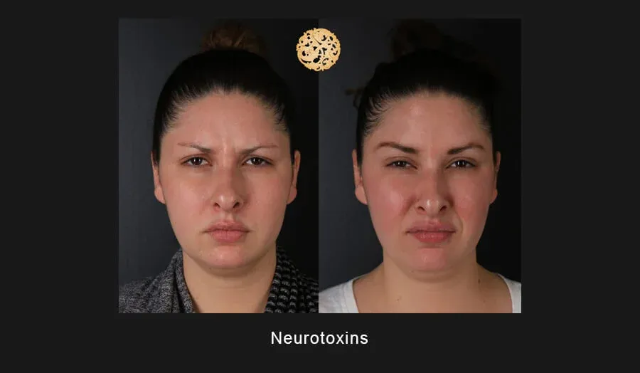 Neurotoxins Before & After
