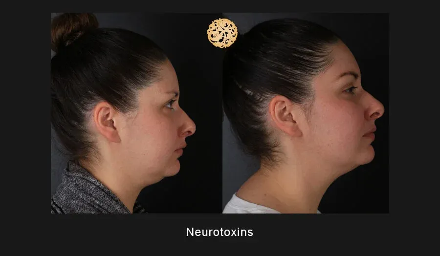 Neurotoxins Before & After