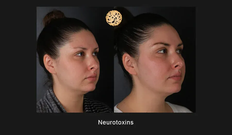 Neurotoxins Before & After