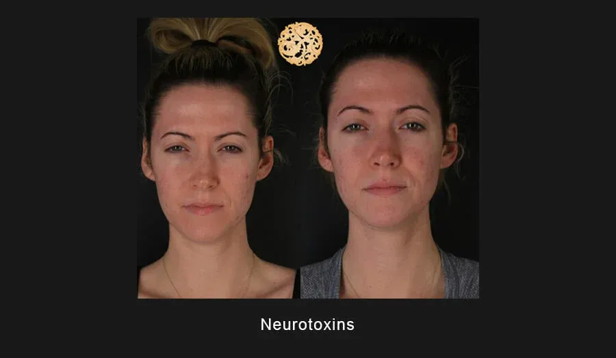 Neurotoxins Before & After