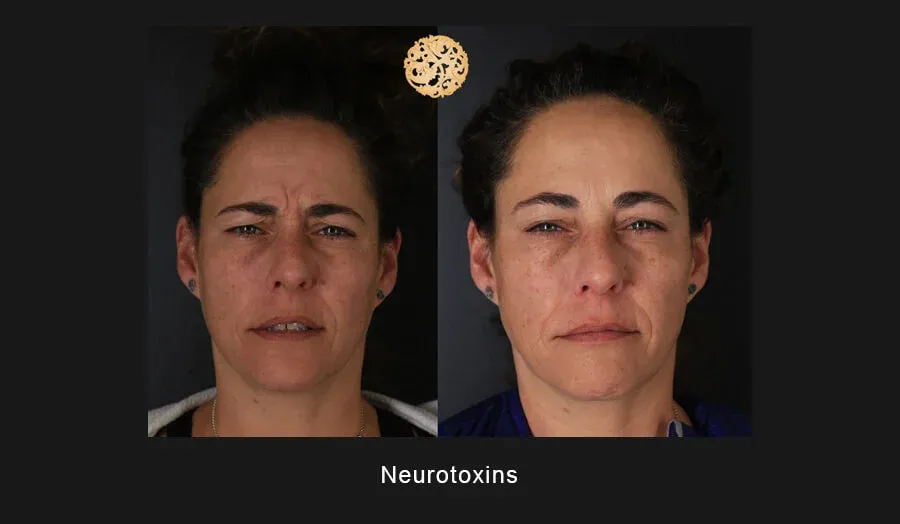 Neurotoxins Before & After