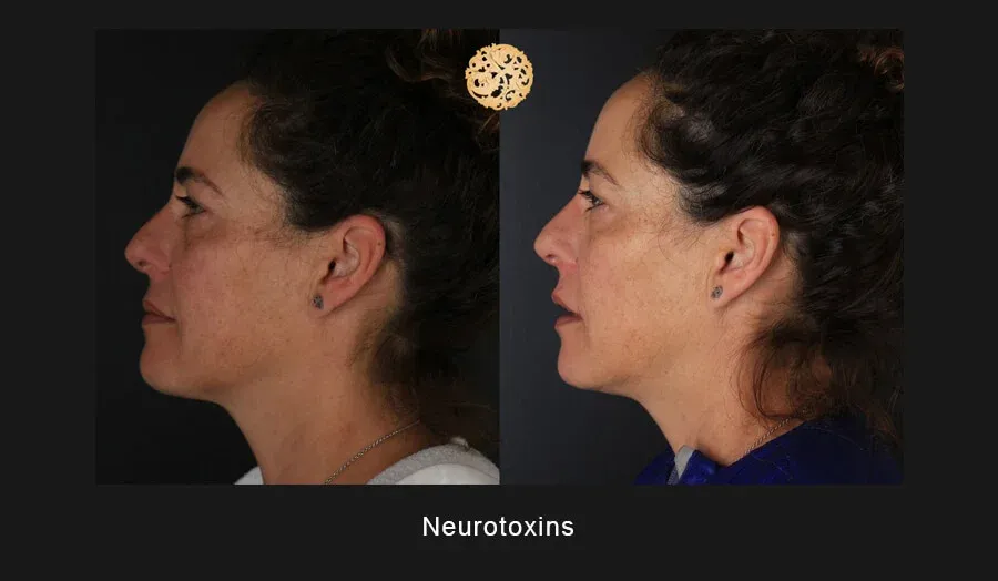 Neurotoxins Before & After