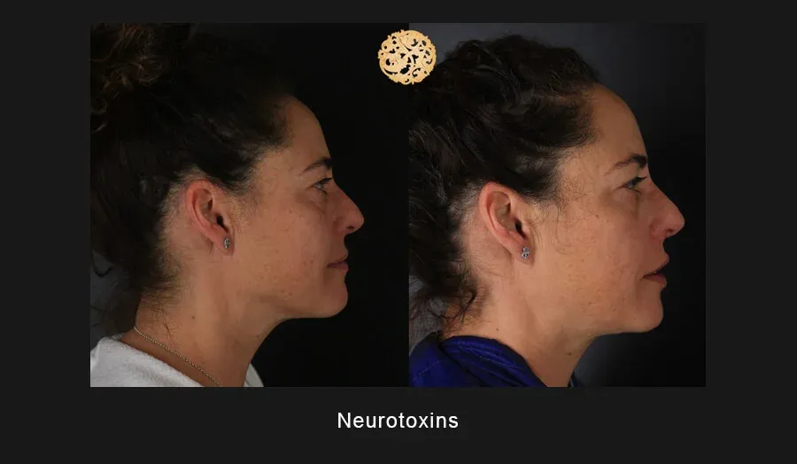 Neurotoxins Before & After