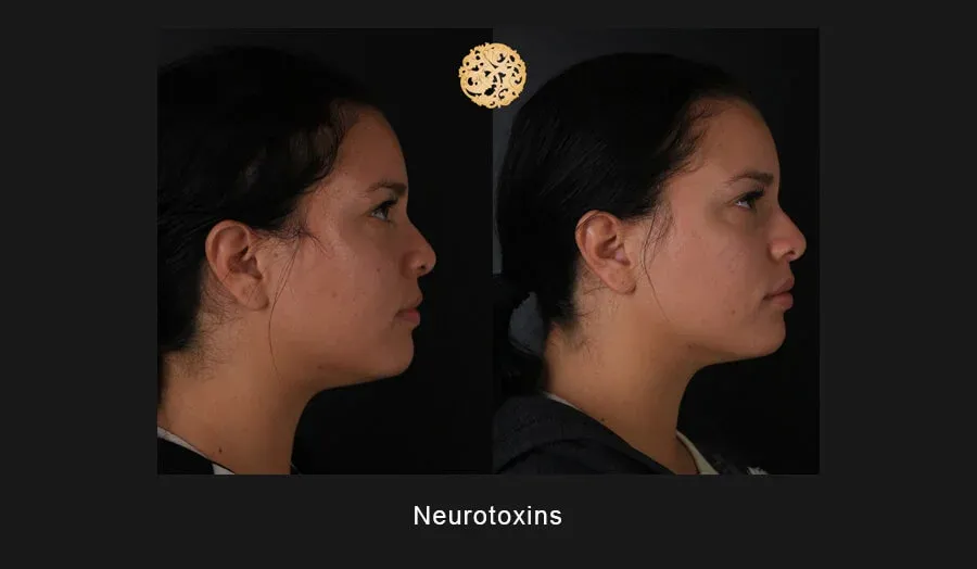 Neurotoxins Before & After