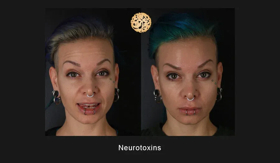 Neurotoxins Before & After