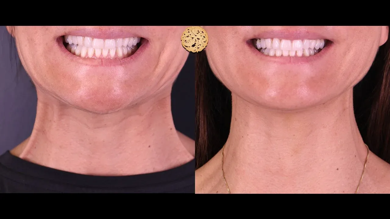 Neurotoxins Before & After