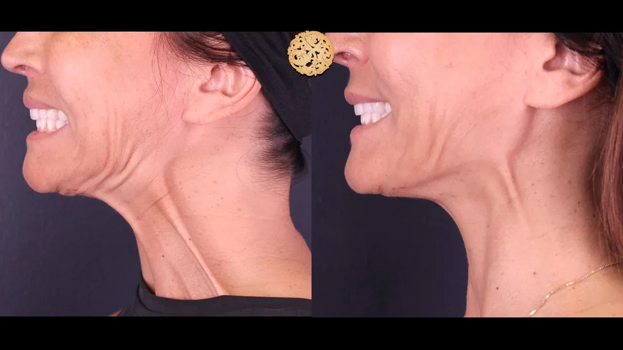 Neurotoxins Before & After