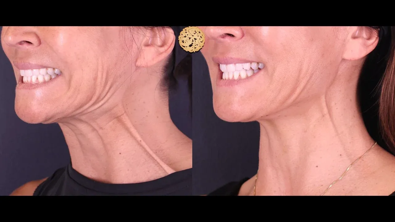 Neurotoxins Before & After