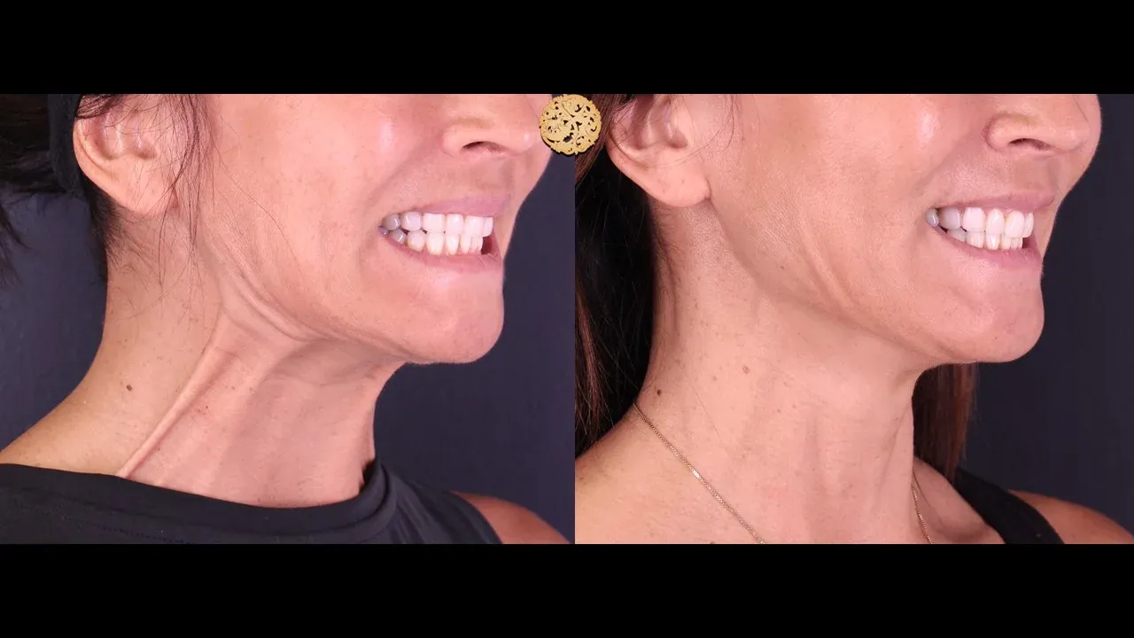 Neurotoxins Before & After