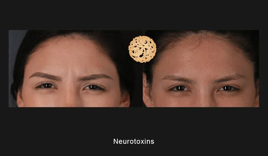 Neurotoxins Before & After