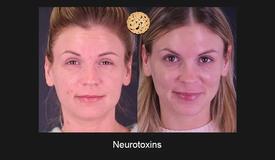 Neurotoxins Before & After