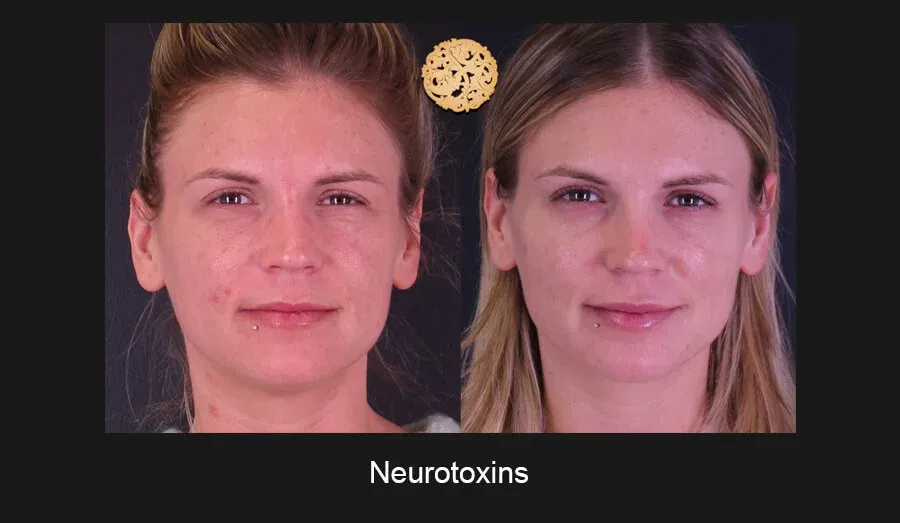 Neurotoxins Before & After