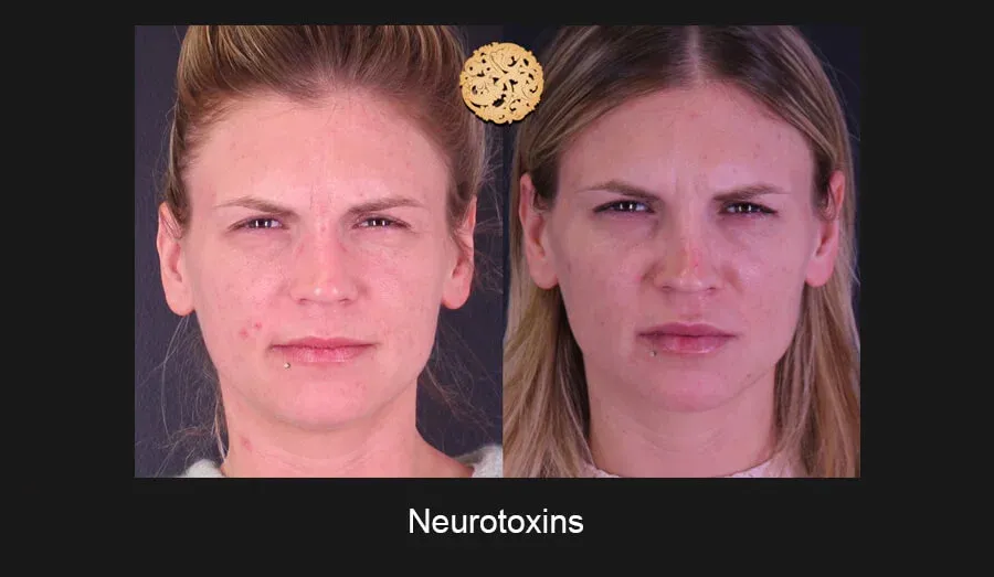 Neurotoxins Before & After