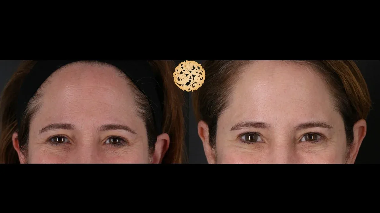 Neurotoxins Before & After