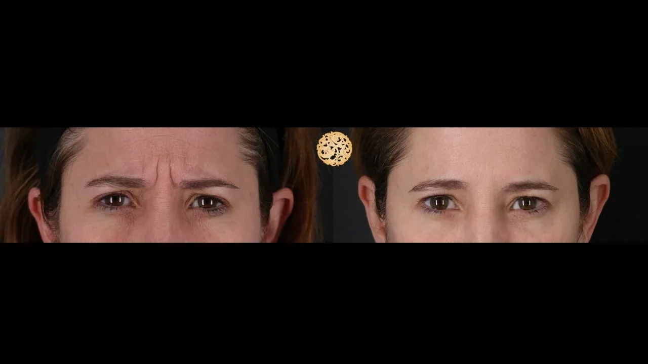 Neurotoxins Before & After