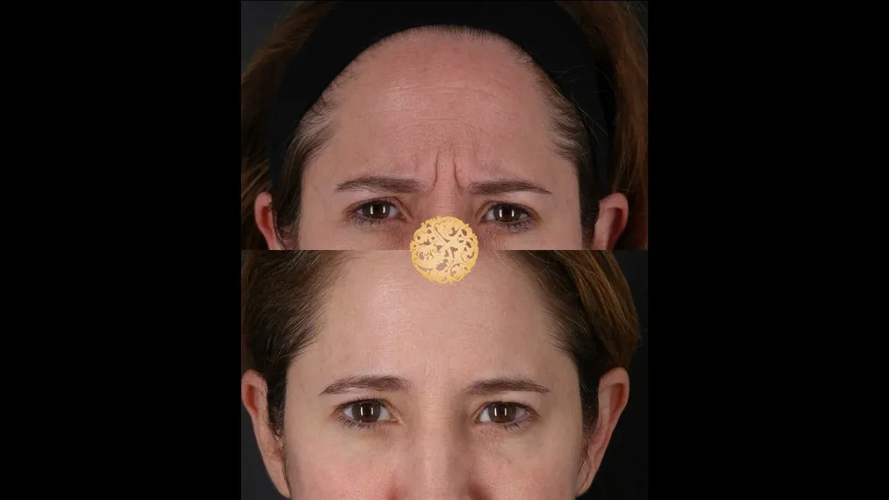 Neurotoxins Before & After