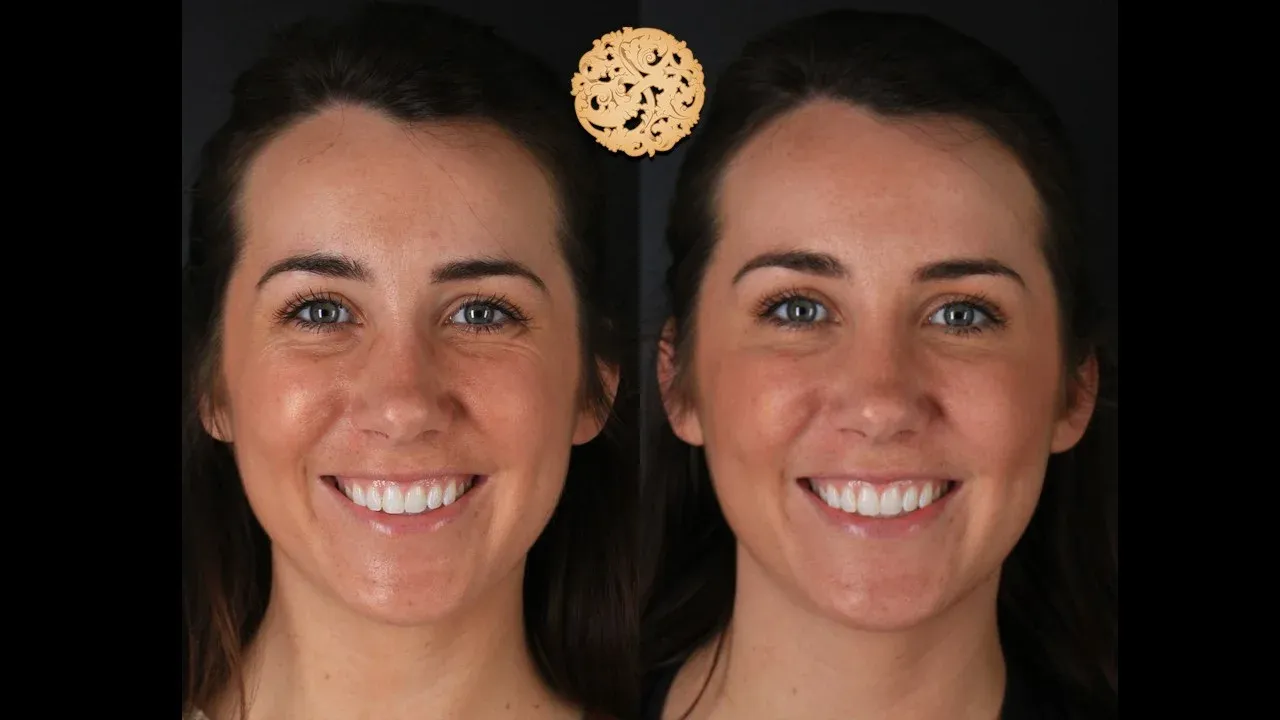 Neurotoxins Before & After