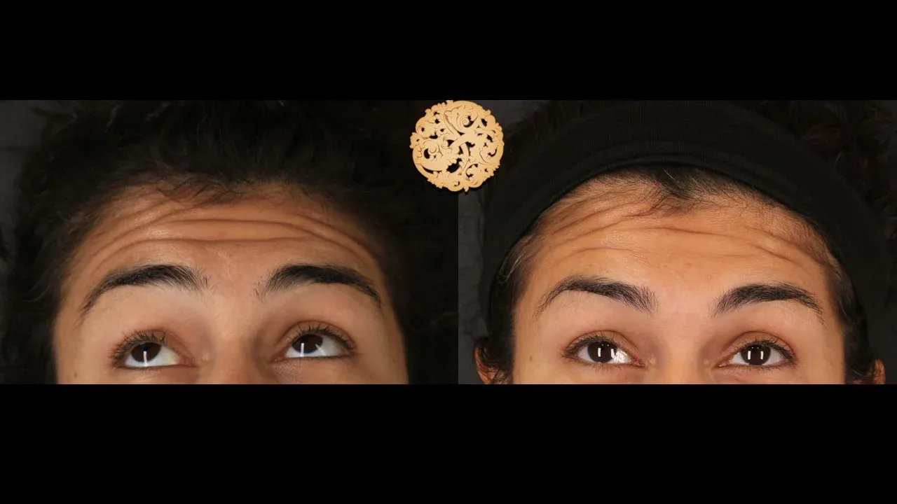 Neurotoxins Before & After