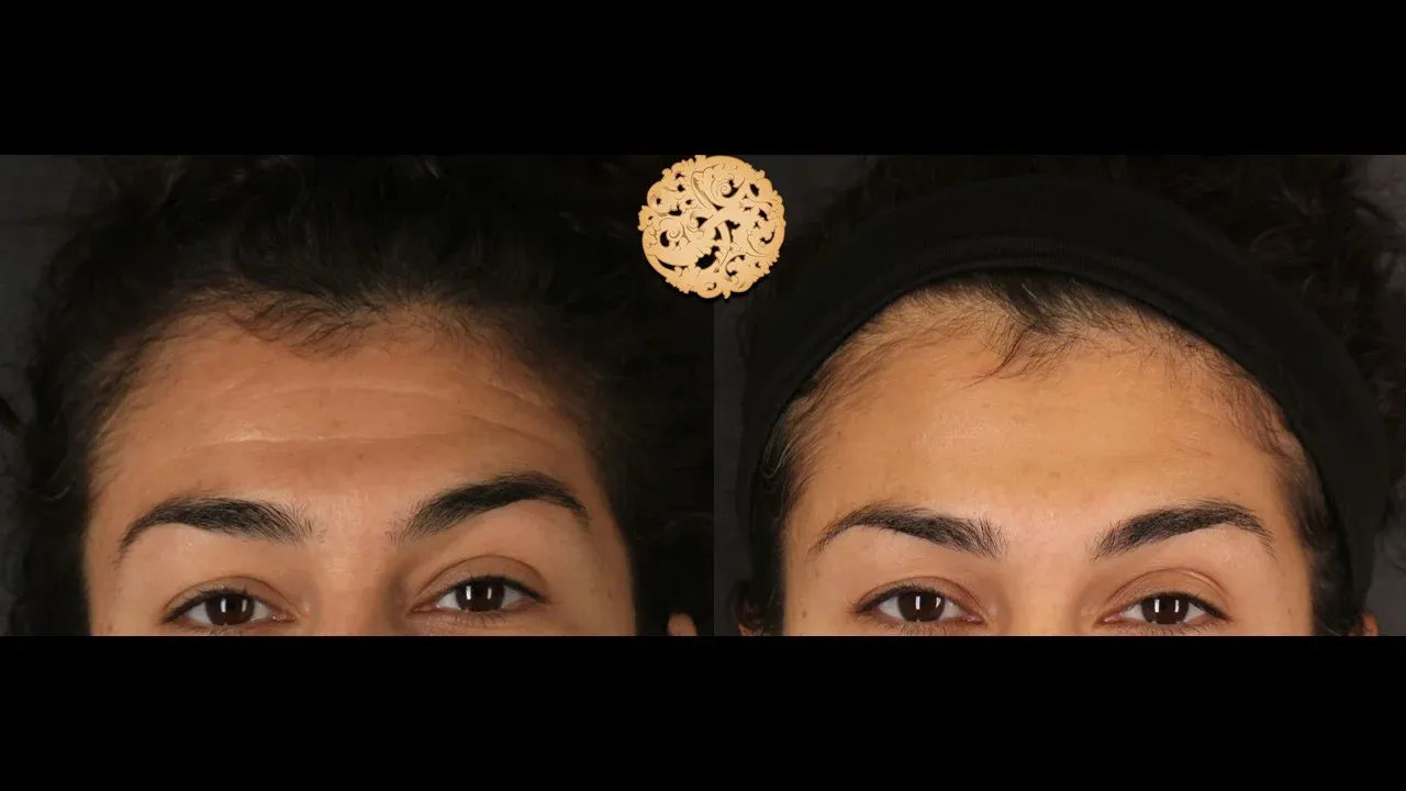 Neurotoxins Before & After