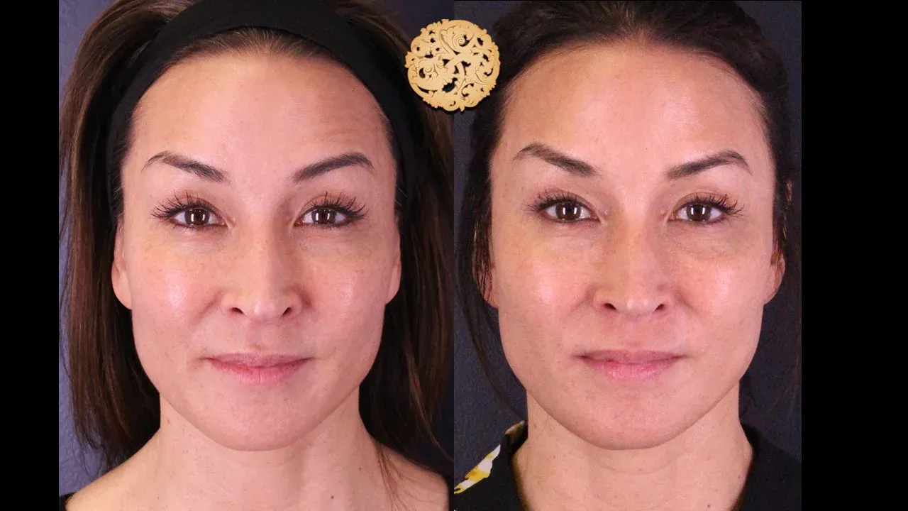 Neurotoxins Before & After