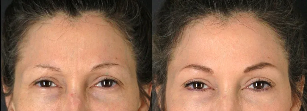 Neurotoxins Before & After