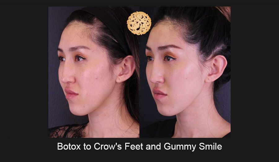 Neurotoxins Before & After