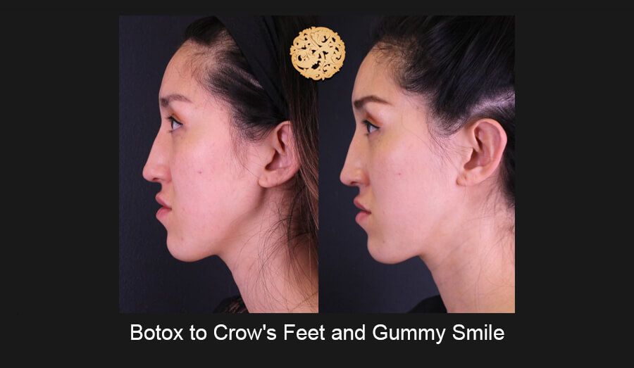 Neurotoxins Before & After