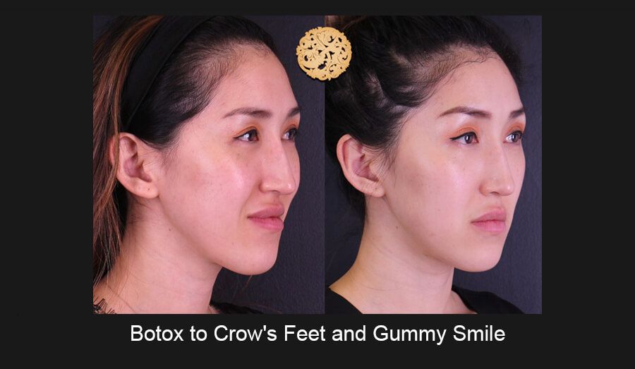 Neurotoxins Before & After