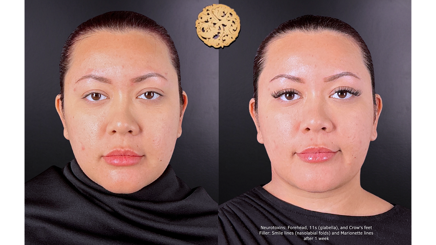 Neurotoxin Before & After