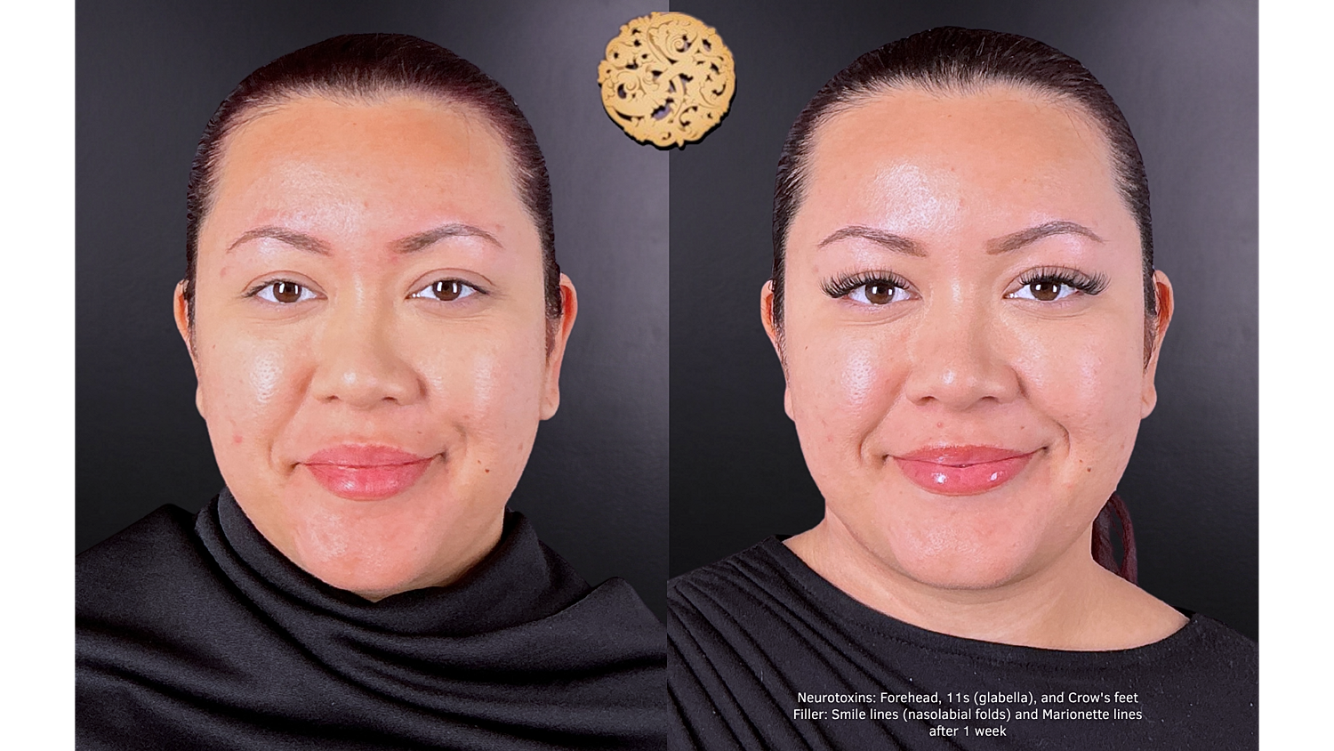 Neurotoxin Before & After