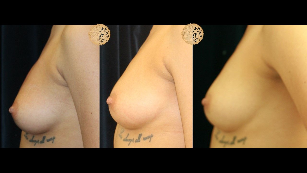 Prp Breast Booster Before & After