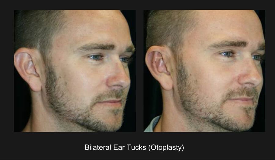 Earlobe Reconstruction Before & After