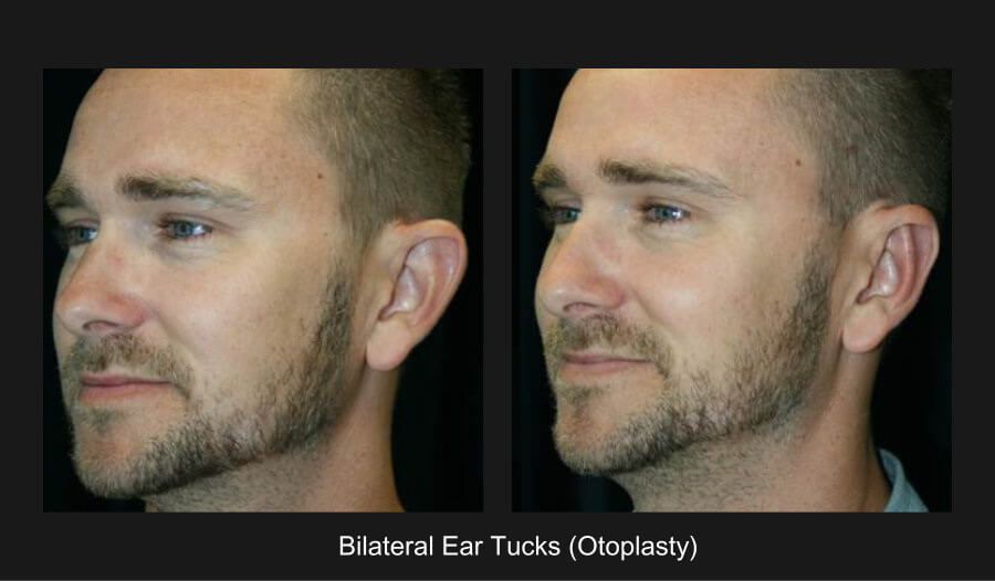 Earlobe Reconstruction Before & After