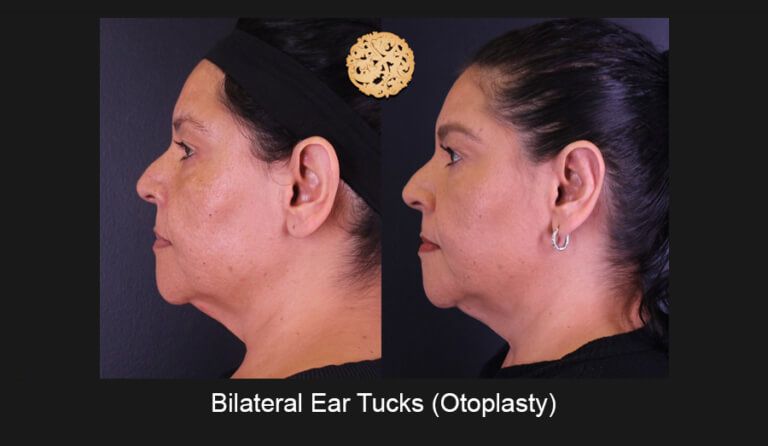 Earlobe Reconstruction Before & After