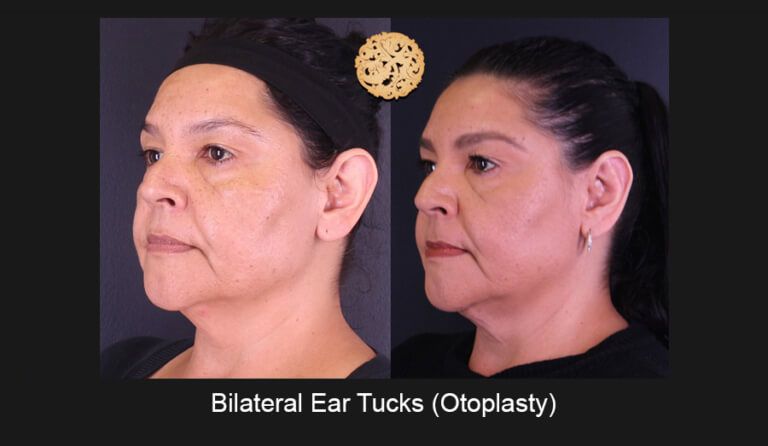 Earlobe Reconstruction Before & After