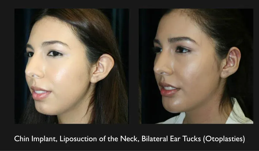 Earlobe Reconstruction Before & After