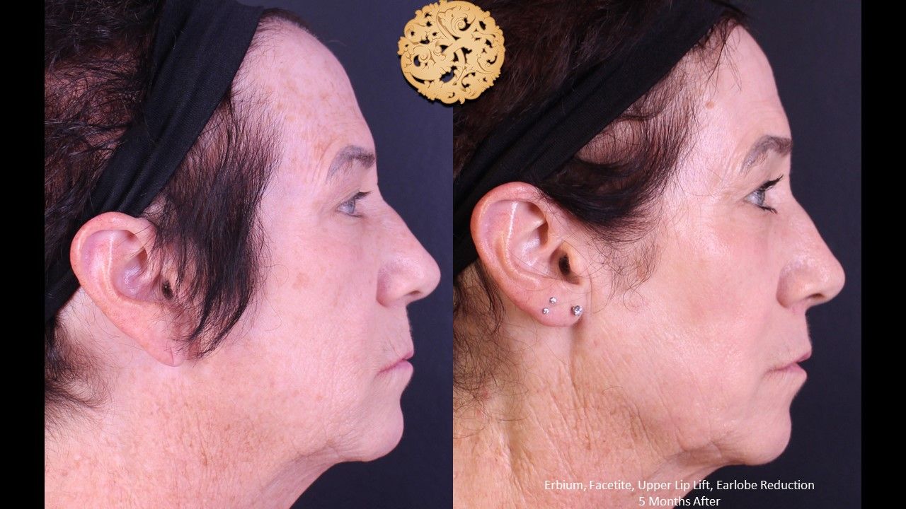 Earlobe Reconstruction Before & After