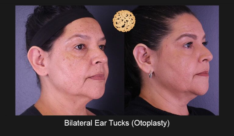 Ear Reconstruction Before & After