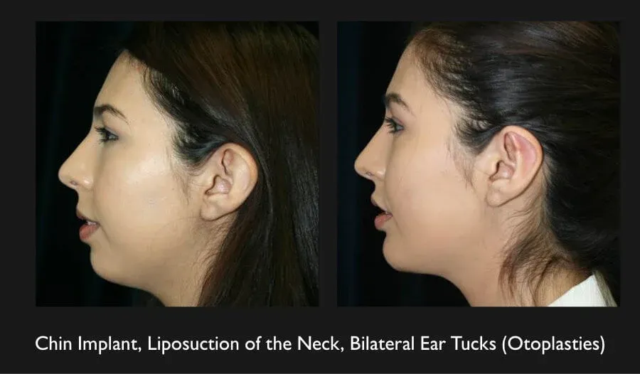 Ear Reconstruction Before & After
