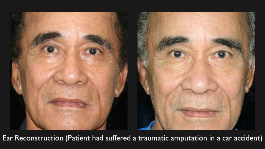 Ear Reconstruction Before & After