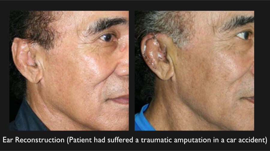 Ear Reconstruction Before & After