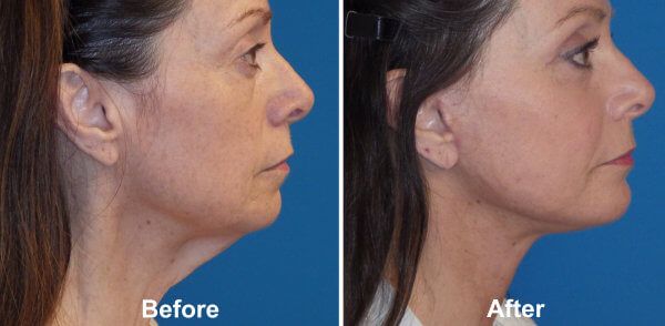 Double Chin Treatment Before & After