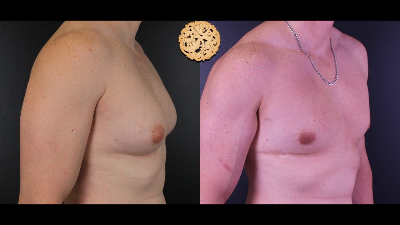 Bodytite Before & After