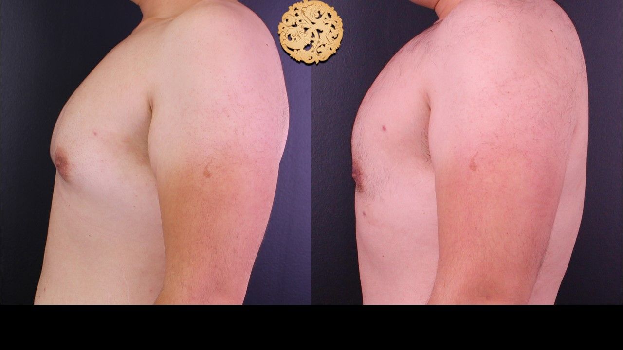 Bodytite Before & After