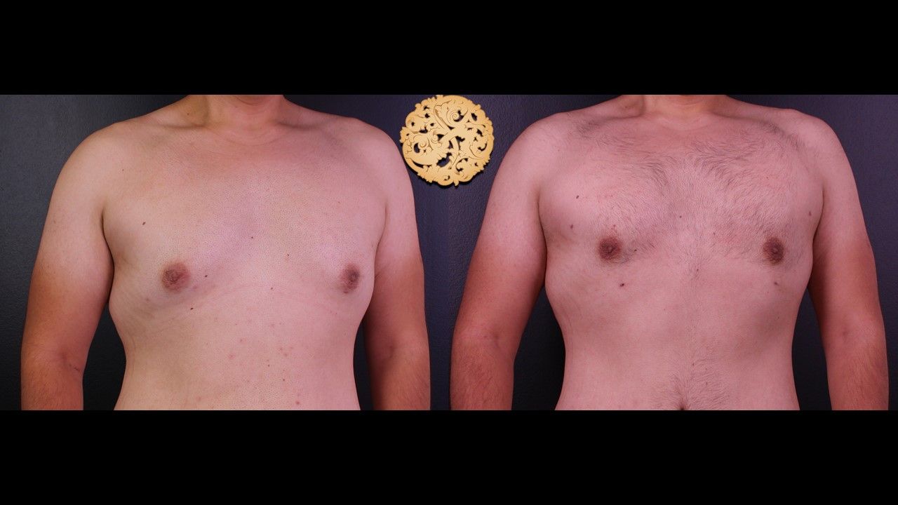 Bodytite Before & After