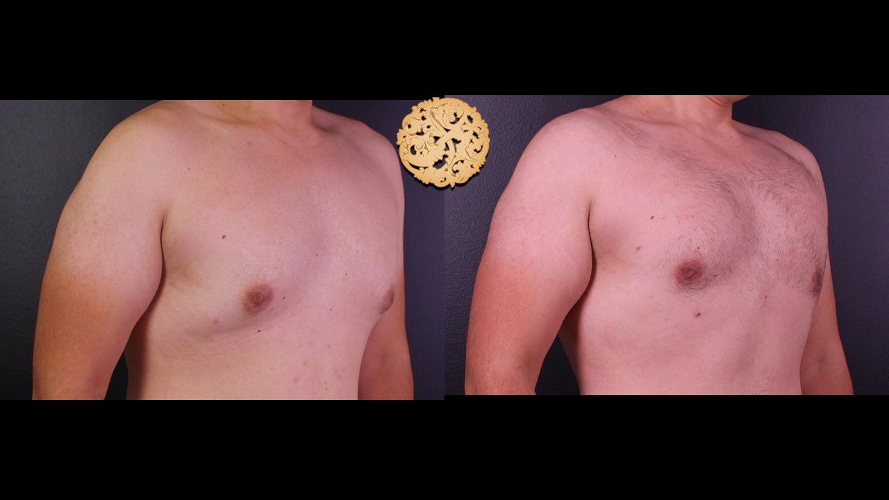 Bodytite Before & After