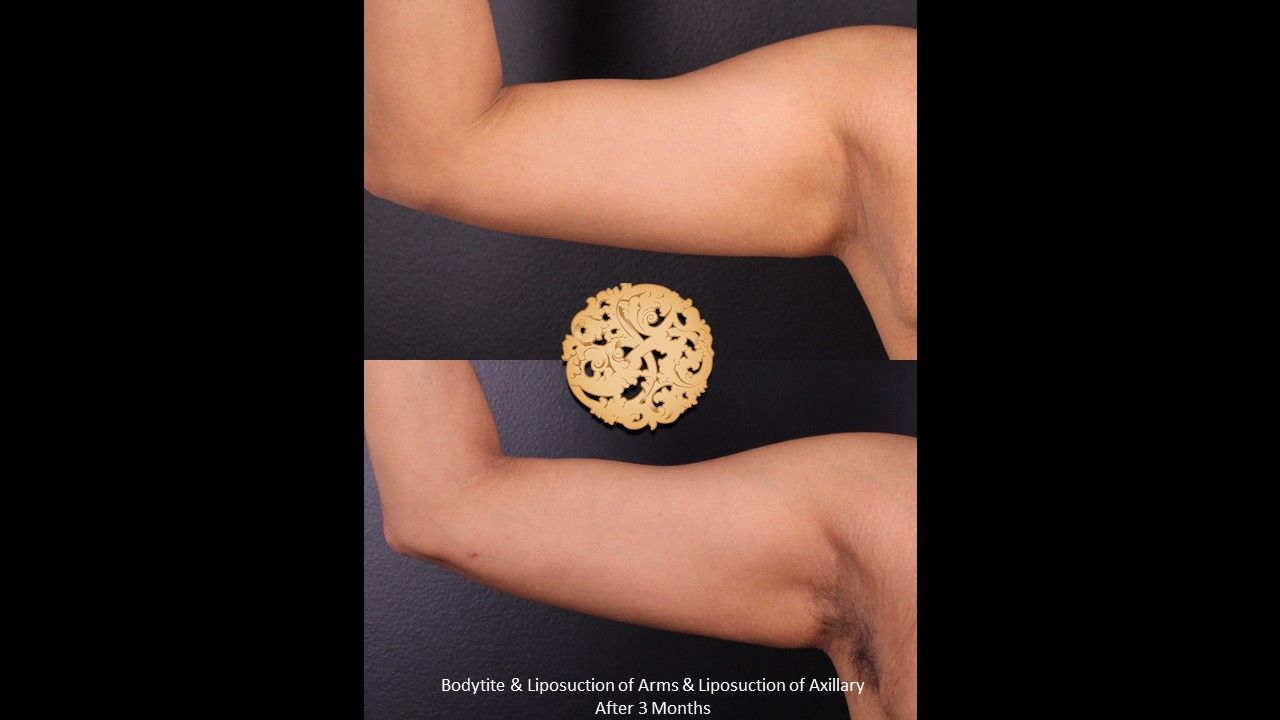 Bodytite Before & After