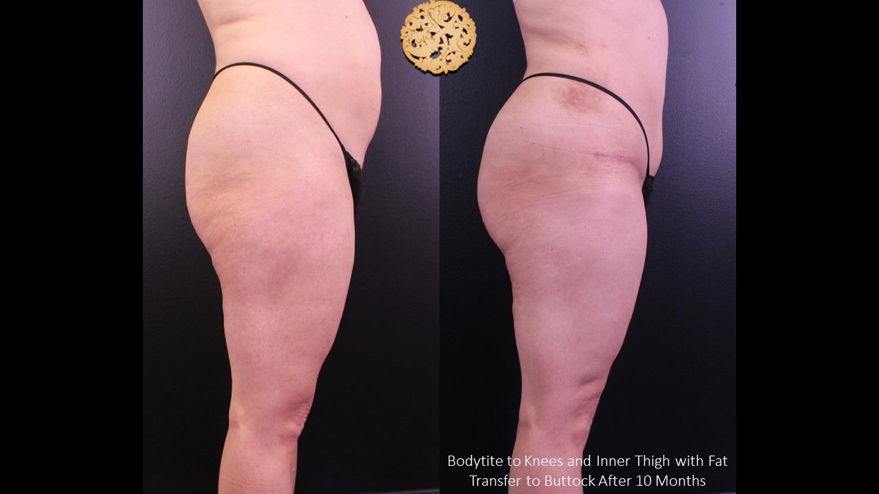 Bodytite Before & After