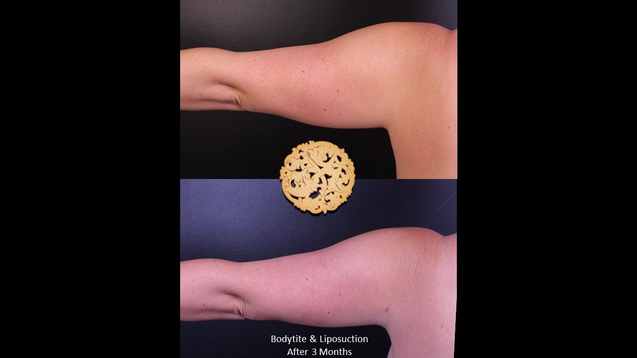 Bodytite Before & After