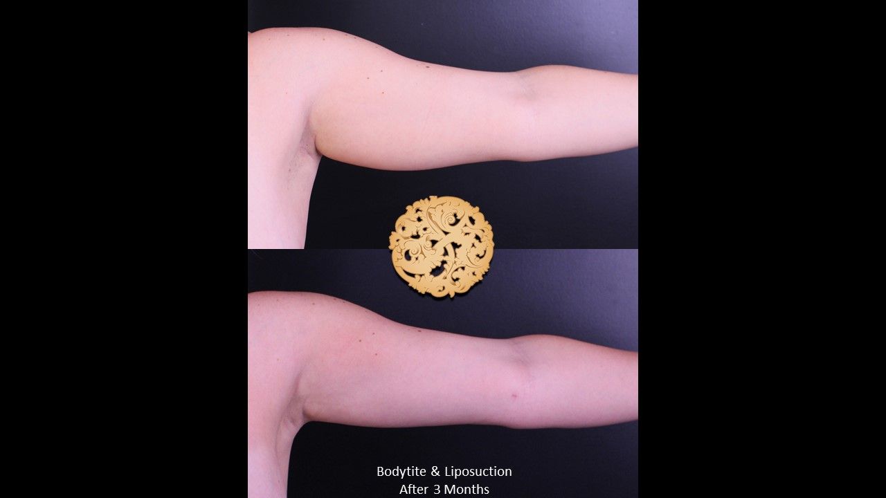 Bodytite Before & After